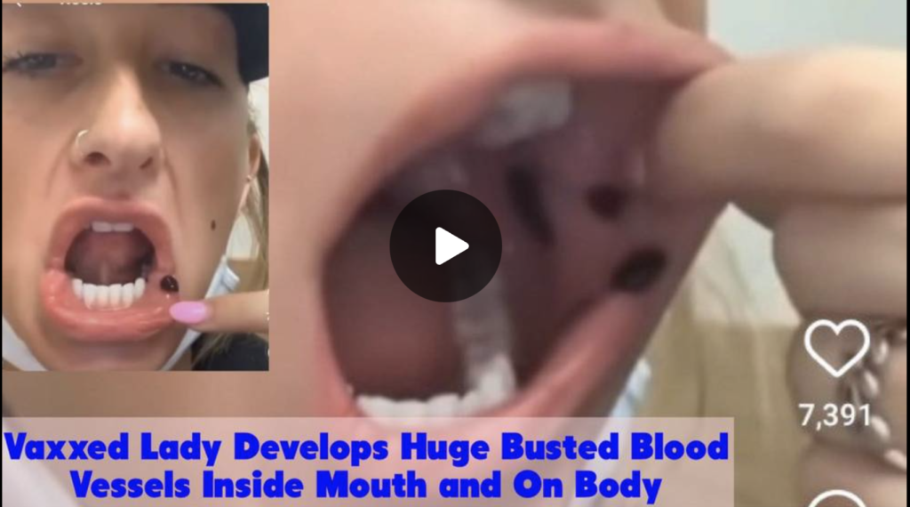 Vaxxed Lady Develops Huge Busted Blood Vessels Inside Mouth and On Body EXZM Zack Mount August 31st 2021